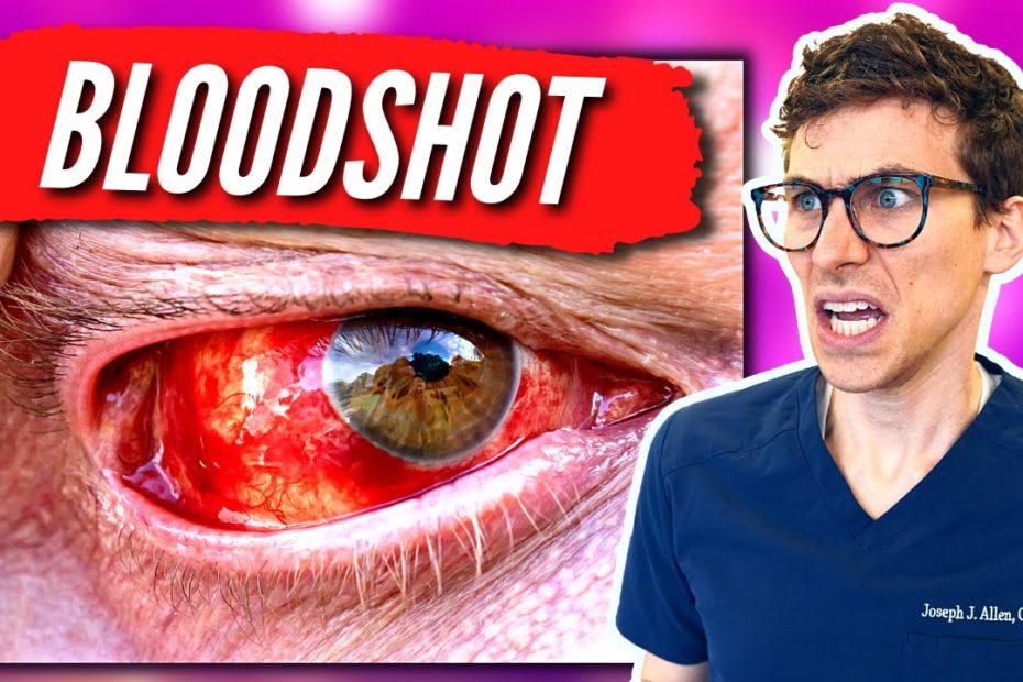 Do Bloodshot Eyes Go Away?