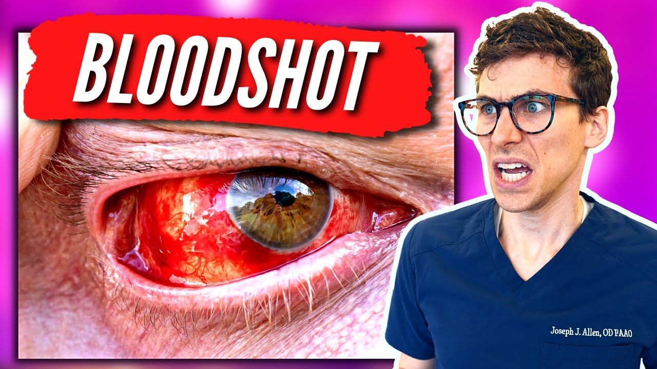 Do Bloodshot Eyes Go Away?