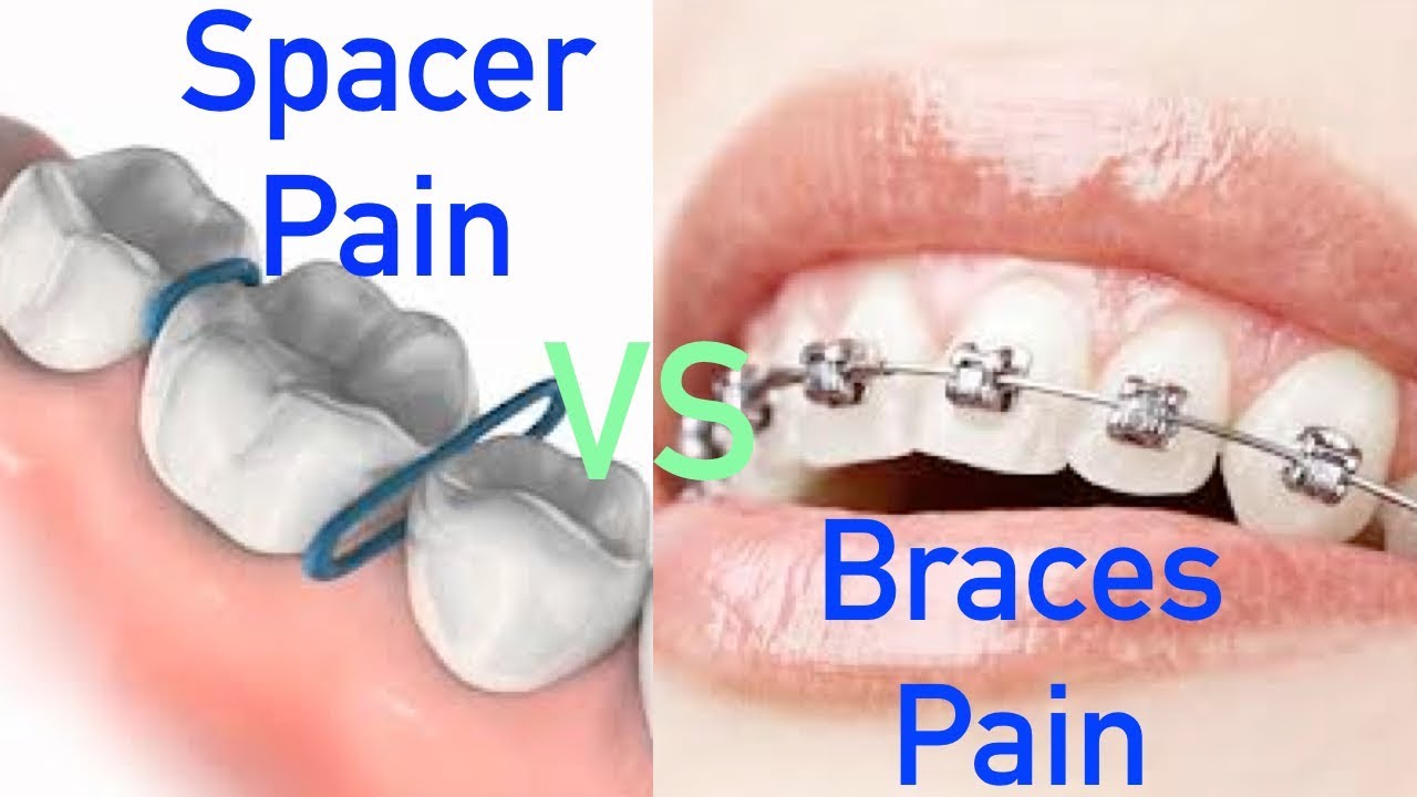 Do Braces Hurt More Than Spacers?