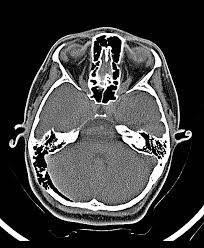 Pneumatization Of Mastoid Air Cells Radiology | What Are Pneumatized Mastoid Air Cells?