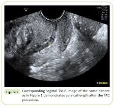 Emergency Cerclage At 21 Weeks: My Story