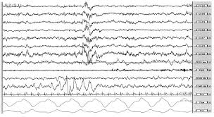 K Complexes And Sleep Spindles | What Are Sleep Spindles And K-Complexes?