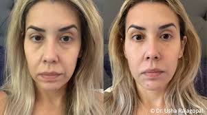 Angel Lift For Nasolabial Folds: A Non-Surgical Solution