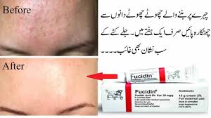 Is It Ok To Put Fucidin On Pimples?