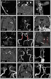 Tortuosity Of The Right Vertebral Artery | What Does It Mean When An Artery Is Tortuous?