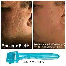 Before & After Acne Treatment Results | Rodan + Fields®
