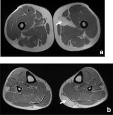 Is Rippling Muscle Disease Fatal: What You Need To Know