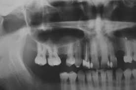 Antral Pseudocyst | Registered Dental Hygienists