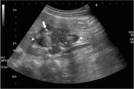 Normal Size Of Periportal Lymph Nodes: What’S Considered Typical?