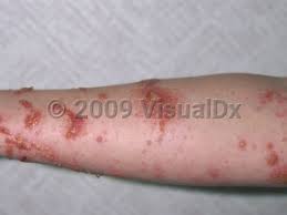 Icd-10 Code For Contact Dermatitis Due To Poison Ivy: What You Need To Know